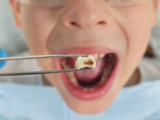Best Emergency Treatment for Toothache in Gibsonia, PA
